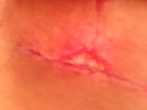 Vết mổ hình chữ T ngược lâu liền sau khi treo ngực sa trễ được 4 tuần?