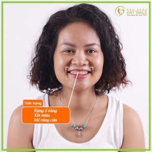 Hình ảnh dán sứ Veneer Laminate – Nha khoa Viet Smile – Ca 10