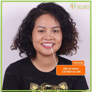 Hình ảnh dán sứ Veneer Laminate – Nha khoa Viet Smile – Ca 10