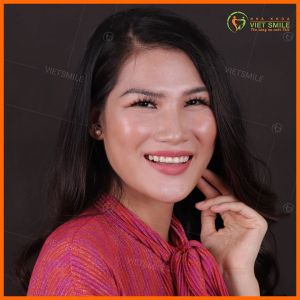 Hình ảnh dán sứ Veneer – Nha khoa Viet Smile – Ca 11
