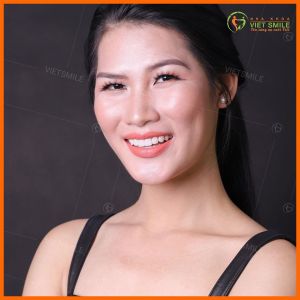Hình ảnh dán sứ Veneer – Nha khoa Viet Smile – Ca 11