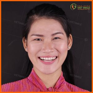 Hình ảnh dán sứ Veneer – Nha khoa Viet Smile – Ca 11