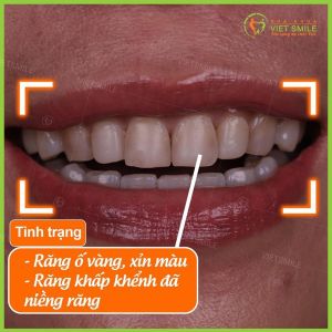 Hình ảnh dán sứ Veneer – Nha khoa Viet Smile – Ca 12