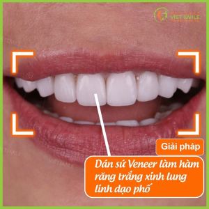 Hình ảnh dán sứ Veneer – Nha khoa Viet Smile – Ca 12