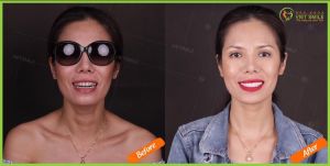 Hình ảnh dán sứ Veneer – Nha khoa Viet Smile – Ca 12
