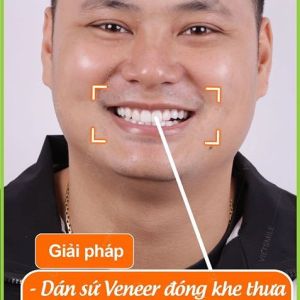 Hình ảnh dán sứ Veneer – Nha khoa Viet Smile – Ca 13