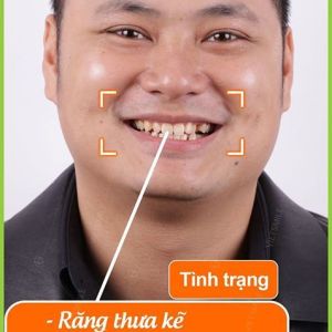 Hình ảnh dán sứ Veneer – Nha khoa Viet Smile – Ca 13