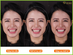 Hình ảnh dán sứ Veneer –Nha khoa Viet Smile – Ca 14