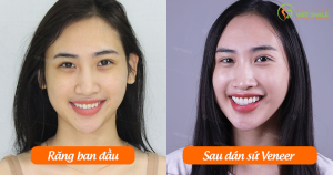 Hình ảnh dán sứ Veneer – Nha khoa Viet Smile – Ca 15