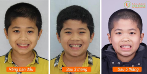 Hình ảnh niềng răng mắc cài của cậu bé 8 tuổi – Nha khoa Viet Smile – Ca 17