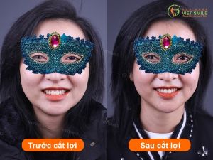 Hình ảnh điều trị cười hở lợi – Nha khoa Viet Smile – Ca 18