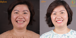 Hình ảnh dán sứ Veneer – Nha khoa Viet Smile – Ca 19