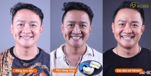 Hình ảnh dán sứ Veneer – Nha khoa Viet Smile – Ca 20
