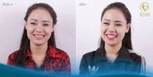 Hình ảnh dán sứ Veneer – Nha khoa Viet Smile – Ca 21