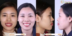 Hình ảnh niềng răng mắc cài – Nha khoa Viet Smile – Ca 22