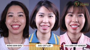 Hình ảnh điều trị cười hở lợi và dán sứ Veneer – Nha khoa Viet Smile – Ca 23