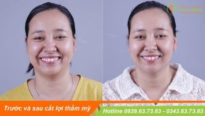 Hình ảnh điều trị cười hở lợi – Nha khoa Viet Smile – Ca 24