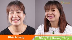 Hình ảnh bọc răng sứ - Nha khoa Viet Smile – Ca 25