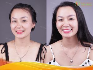 Hình ảnh dán sứ Veneer – Nha khoa Viet Smile – Ca 26
