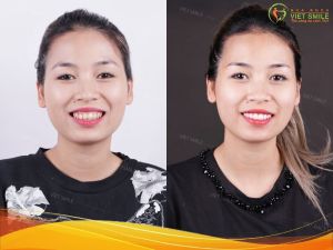 Hình ảnh dán sứ Veneer – Nha khoa Viet Smile – Ca 27