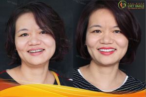Hình ảnh dán sứ Veneer của KH Đoàn Quỳnh Hoa – Nha khoa Viet Smile – Ca 28