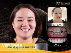 Hình ảnh niềng răng mắc cài và dán sứ Veneer – Nha khoa Viet Smile – Ca 29