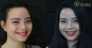 Hình ảnh dán sứ Veneer – Nha khoa Viet Smile – ca 2