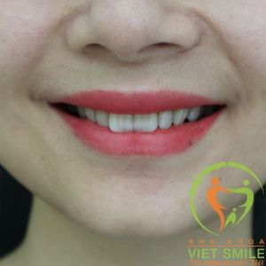 Hình ảnh dán sứ Veneer – Nha khoa Viet Smile – ca 2