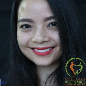 Hình ảnh dán sứ Veneer – Nha khoa Viet Smile – ca 2