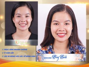 Hình ảnh dán sứ Veneer của KH Hồng Hạnh – Nha khoa Viet Smile – Ca 30