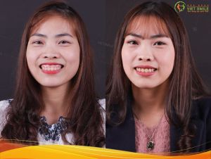 Hình ảnh điều trị cười hở lợi cuả KH Phạm Thị Nguyện – Nha khoa Viet Smile – Ca 31