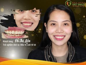 Hình ảnh điều trị cười hở lợi của KH Đỗ Thị Liễu – Nha khoa Viet Smile – Ca 32