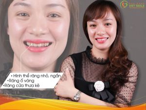 Hình ảnh dán sứ Veneer của KH Nguyễn Thị Hương – Nha khoa Viet Smile – Ca 33