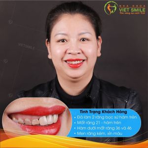Hình ảnh bọc răng sứ của KH Lan Hương – Nha khoa Viet Smile – ca 34