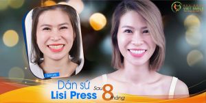 Hình ảnh dán sứ Veneer của KH Hồng Giang – Nha khoa Viet Smile – Ca 35