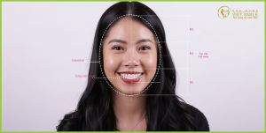 Hình ảnh bọc răng sứ của chị Dung - Nha khoa Viet Smile – Ca 3