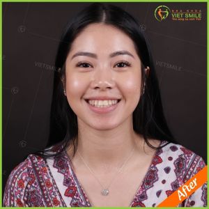 Hình ảnh bọc răng sứ của chị Dung - Nha khoa Viet Smile – Ca 3