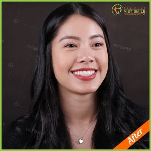 Hình ảnh bọc răng sứ của chị Dung - Nha khoa Viet Smile – Ca 3