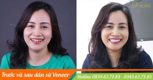 Hình ảnh dán sứ Veneer của KH H.T.H.Nhạn – Nha khoa Viet Smile – Ca 4