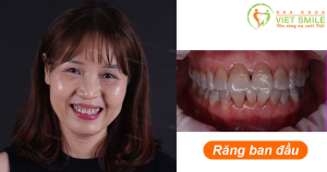 Hình ảnh dán sứ Veneer – Nha khoa Viet Smile – Ca 5