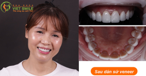 Hình ảnh dán sứ Veneer – Nha khoa Viet Smile – Ca 5