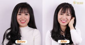 Hình ảnh dán sứ Veneer 20 răng – Nha khoa Viet Smile – ca 6