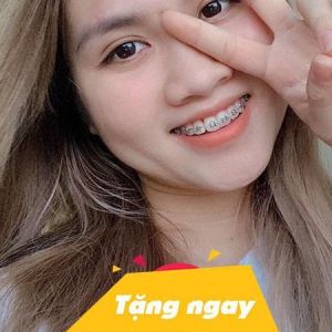 Hình ảnh niềng răng mắc cài - Nha khoa Viet Smile – ca 7