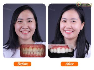 Hình ảnh dán sứ Veneer của KH Thanh Huyền – Nha khoa Viet Smile – Ca 8