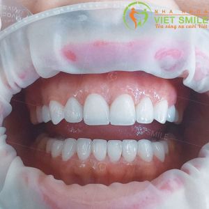 Hình ảnh dán sứ Veneer – Nha khoa Viet Smile – Ca 9