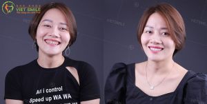 Hình ảnh dán sứ Veneer – Nha khoa Viet Smile – Ca 9