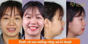 Hình ảnh niềng răng mắc cài – Nha khoa Viet Smile – Ca 1