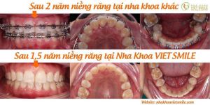 Hình ảnh niềng răng mắc cài – Nha khoa Viet Smile – Ca 1