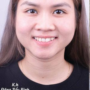 Hình ảnh niềng răng mắc cài - Nha khoa Viet Smile – ca 7
