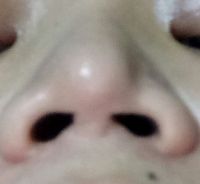 Nâng mũi hơn 8 năm có gây ra viêm xoang/viêm mũi không? Nâng mũi hơn 8 năm có gây ra viêm xoang/viêm mũi không?